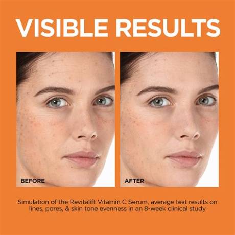 Before and After at the C Spot La: Dermatologist Insights and Treatment Results
