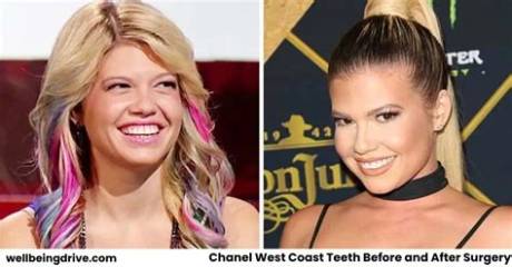 Chanel West Coast Teeth Before and After 2021: Visual Evidence and Procedure Breakdown