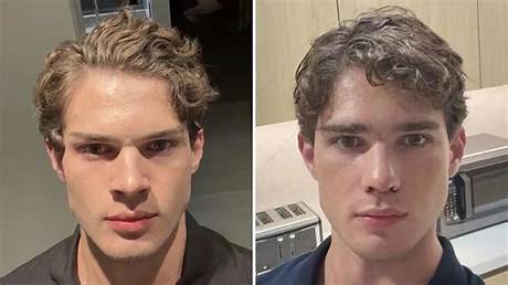 Clavicular Nose Surgery Timeline: from Live Dr. Miami Operation to Viral Online Roast