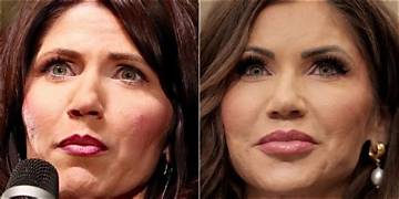 Did Kristi Noem Get Plastic Surgery? Fact-Checking Rumors, Expert Claims, and Reality