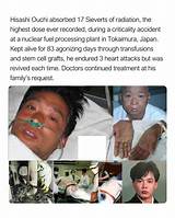 Hisashi Ouchi Medical Photos: a Tragic Case of Radiation Exposure