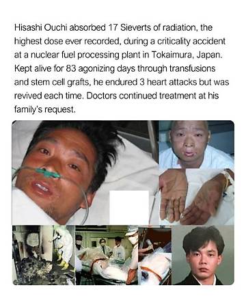 Hisashi Ouchi Medical Photos: a Tragic Case of Radiation Exposure