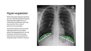 How Tall Is Clavicular? Fact-Checking Rumors, Claims, and Surgeries