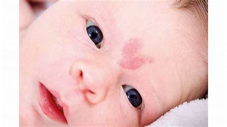 Is a Stork Bite Really a Warning Sign of Mthfr Mutation? Viral Panic Debunked