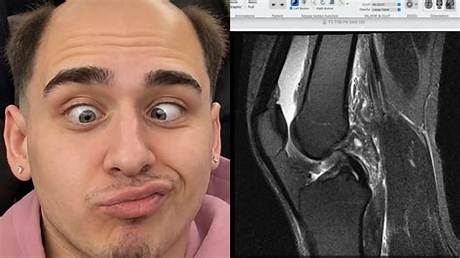Lacy Knee Surgery Explained: Diagnosis, Stream Hiatus, and Expected Recovery Timeline