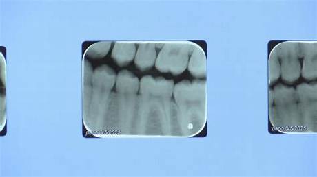 Madison Marks 12 Months Without Water Fluoride as Dental Warnings Escalate