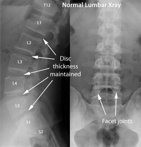 What Lumbago Looks Like on Scans: Anatomy of Acute Lower Back Pain