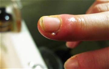 Why You Should Never Rip a Hangnail: the Hidden Danger of Sepsis and Paronychia